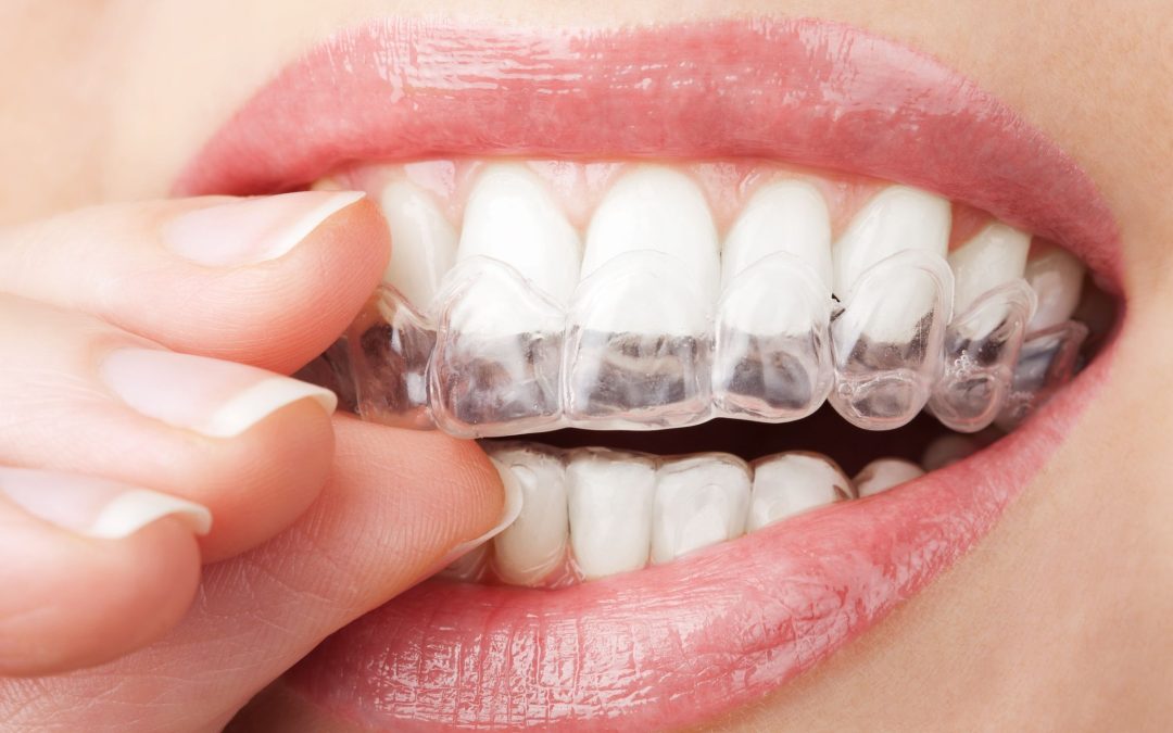 4 Ways Invisalign In Oxnard, CA, Corrects Overbites